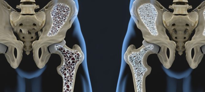Everything you need to know about Osteoporosis